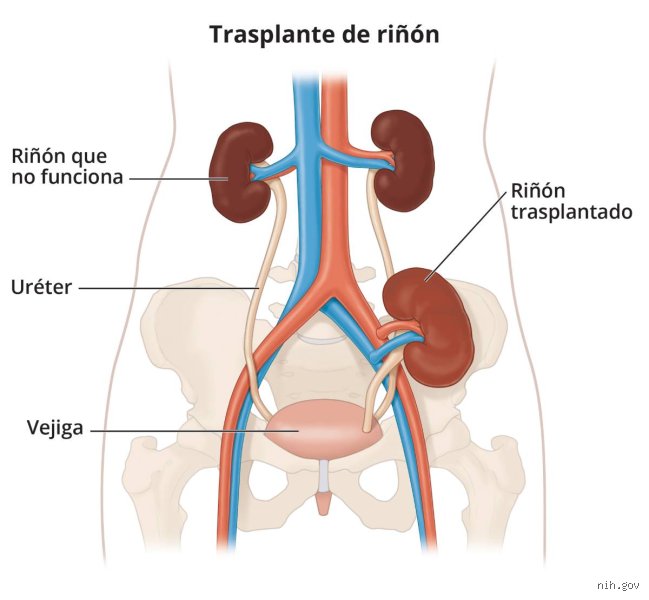 ¿Pueden recuperarse los riñones dañados?