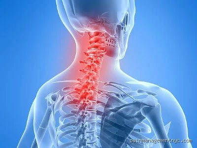 ¿Tiene cura la artritis de cuello?