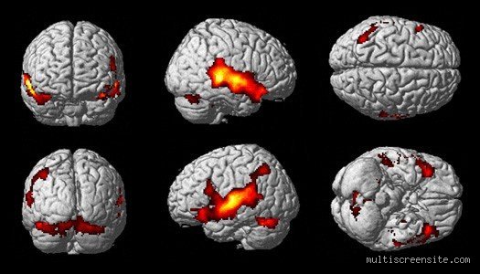 ¿Cuál es la enfermedad cerebral más grave?