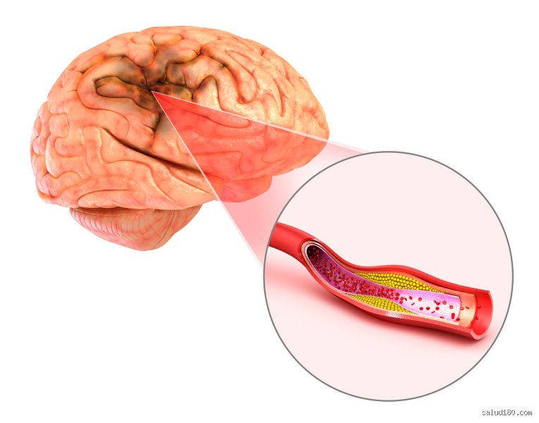 ¿Cuáles son los síntomas de falta de oxígeno en el cerebro?