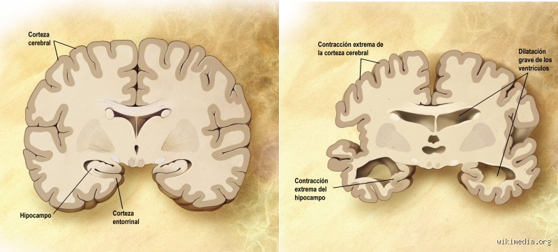 ¿Cuál es la etapa final de la degeneración senil del cerebro?