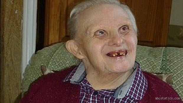 ¿Cuántos años máximo vive una persona con síndrome de Down?