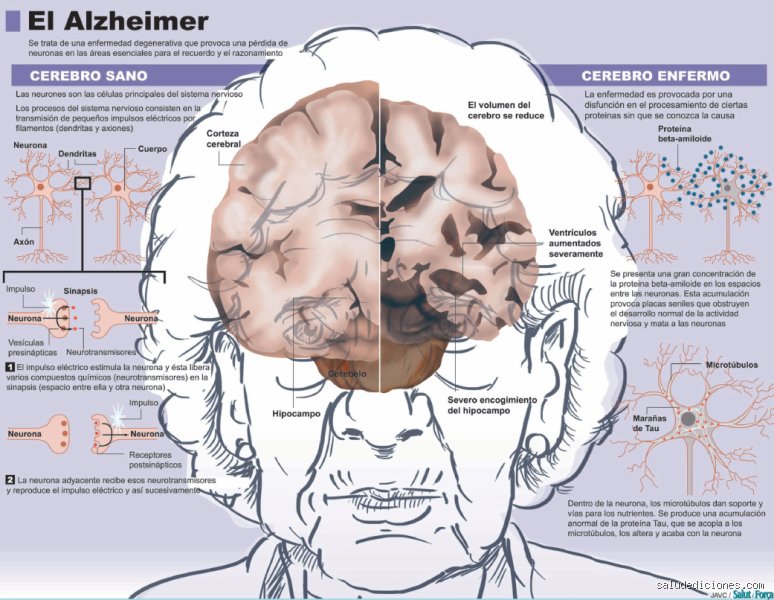 ¿Se vive más tiempo con Alzheimer o demencia?