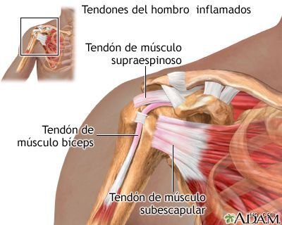 ¿Tocar el piano puede causar tendinitis?
