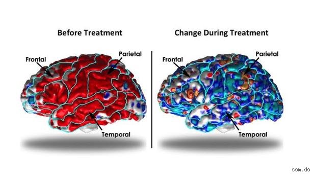 ¿Puede el cerebro recuperarse completamente de la depresión?