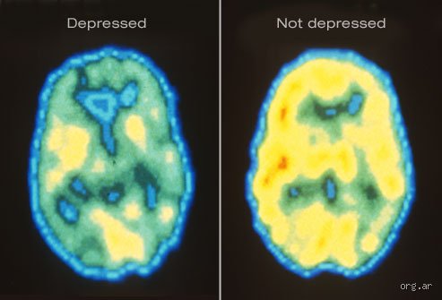 ¿Qué falta en el cerebro cuando hay depresión?