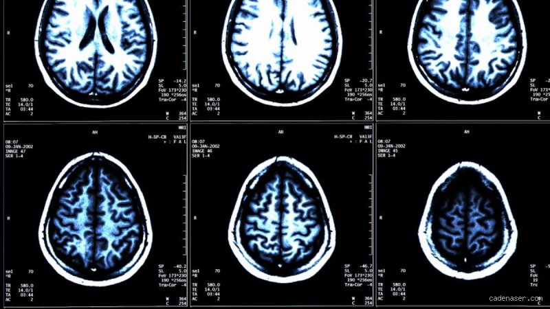 ¿Cuánto puede vivir una persona con insomnio familiar fatal?