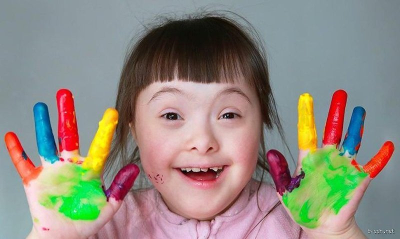 ¿El síndrome de Down es una forma de autismo?